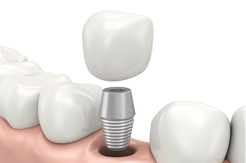 Put Dental Implants On Your Holiday Wish List