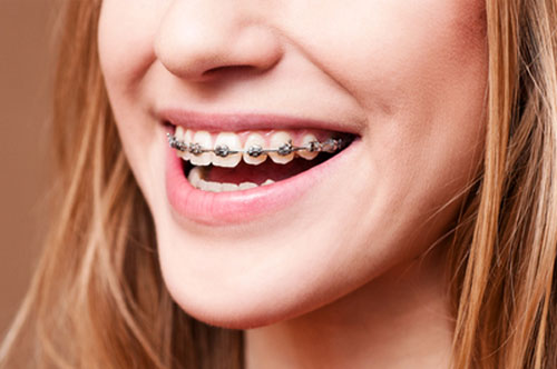 4 Benefits Of Braces [INFOGRAPHIC]