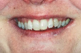 Misaligned Teeth Before Dental Procedure Photo at Friendly Smiles Center in Mount Laurel, NJ