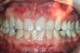 Patient's Teeth After Orthodontics Treatment After Dental Procedure Photo at Friendly Smiles Center in Mount Laurel, NJ