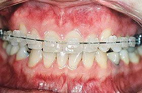 Patient with Clear Braces Before Dental Procedure Photo at Friendly Smiles Center in Mount Laurel, NJ