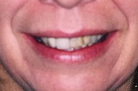 Stained Teeth Before Dental Procedure Photo at Friendly Smiles Center in Mount Laurel, NJ