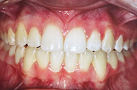 After Dental Procedure Photo at Friendly Smiles Center in Mount Laurel, NJ