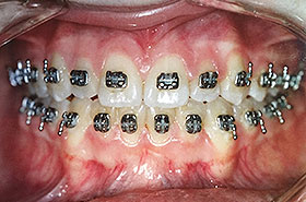Teeth with Traditional Braces Before Dental Procedure Photo at Friendly Smiles Center in Mount Laurel, NJ