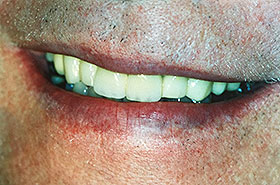 Restored Teeth with Cavities cleaned and tooth replaced After Dental Procedure Photo at Friendly Smiles Center in Mount Laurel, NJ