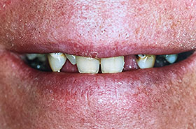 Missing Tooth, Cavities and Yellowish Tooth Before Dental Procedure Photo at Friendly Smiles Center in Mount Laurel, NJ