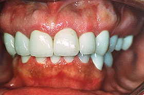 Cleaned and Restored Teeth After Dental Procedure Photo at Friendly Smiles Center in Mount Laurel, NJ