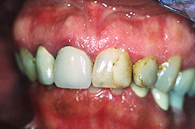 Teeth with Cavities Before Dental Procedure Photo at Friendly Smiles Center in Mount Laurel, NJ