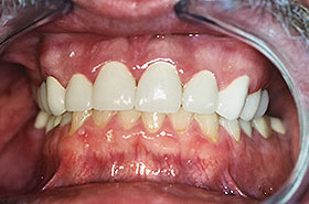 Restored Teeth After Dental Procedure Photo at Friendly Smiles Center in Mount Laurel, NJ