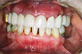 Yellowish Teeth and Gaps between teeth After Dental Procedure Photo at Friendly Smiles Center in Mount Laurel, NJ