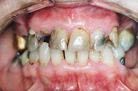 Damaged Teeth due to Cavity and Plaque Before Dental Procedure Photo at Friendly Smiles Center in Mount Laurel, NJ