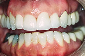 Fixed Gaps Between Teeth After Dental Procedure Photo at Friendly Smiles Center in Mount Laurel, NJ