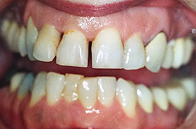 Gaps between Teeth Before Dental Procedure Photo at Friendly Smiles Center in Mount Laurel, NJ