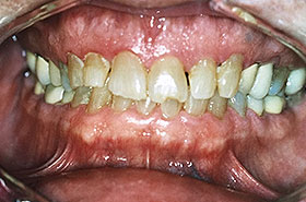 Patient with chipped tooth and gaps in teeth Before Dental Procedure Photo at Friendly Smiles Center in Mount Laurel, NJ