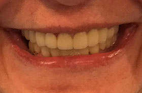 Patient 1's Fixed Teeth After Dental Procedure Photo at Friendly Smiles Center in Mount Laurel, NJ