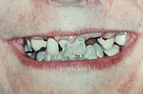Patient 1's Broken Teeth Before Dental Procedure Photo at Friendly Smiles Center in Mount Laurel, NJ