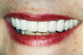 Teeth After Whitening Treatment After Dental Procedure Photo at Friendly Smiles Center in Mount Laurel, NJ