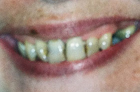 Damaged and Yellowish Teeth Before Dental Procedure Photo at Friendly Smiles Center in Mount Laurel, NJ