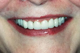 Fixed Damaged Teeth After Dental Procedure Photo at Friendly Smiles Center in Mount Laurel, NJ