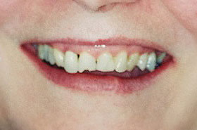 Chipped Teeth Before Dental Procedure Photo at Friendly Smiles Center in Mount Laurel, NJ