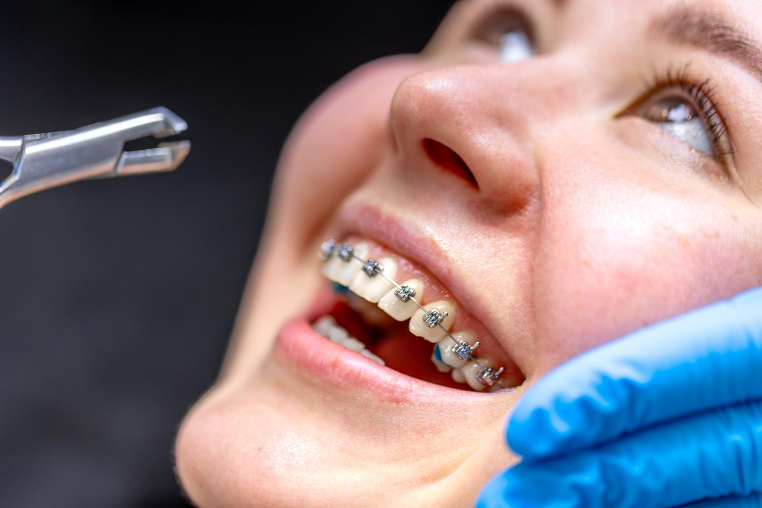 braces